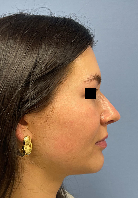 RHINOPLASTY Before & After Gallery - Patient 416568 - Image 5