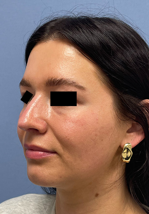 RHINOPLASTY Before & After Gallery - Patient 416568 - Image 7