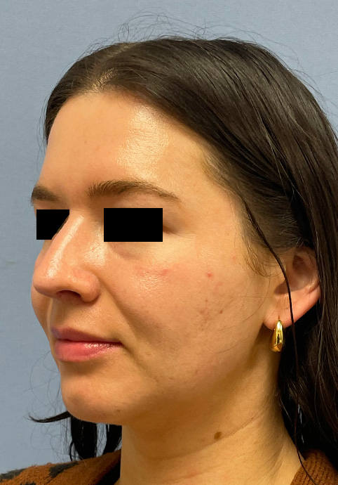 RHINOPLASTY Before & After Gallery - Patient 416568 - Image 8