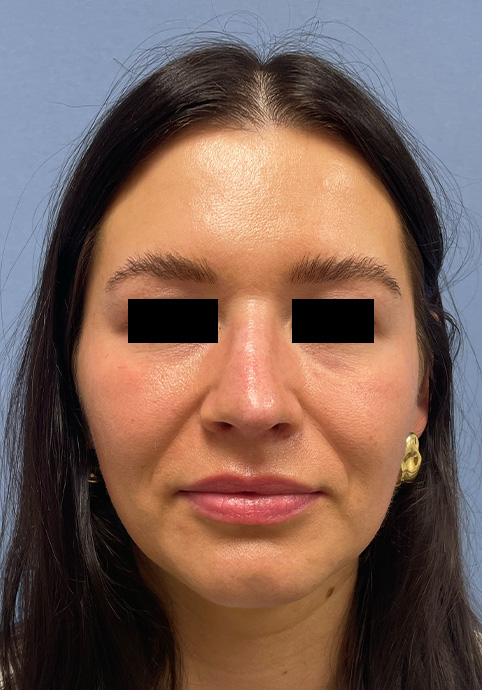 RHINOPLASTY Before & After Gallery - Patient 416568 - Image 1