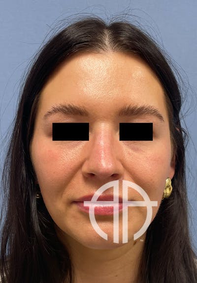 RHINOPLASTY Before & After Gallery - Patient 416568 - Image 1