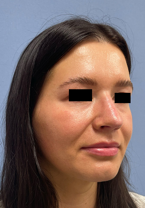 RHINOPLASTY Before & After Gallery - Patient 416568 - Image 3