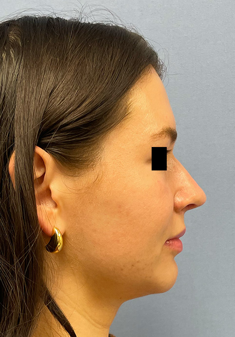 RHINOPLASTY Before & After Gallery - Patient 416568 - Image 6