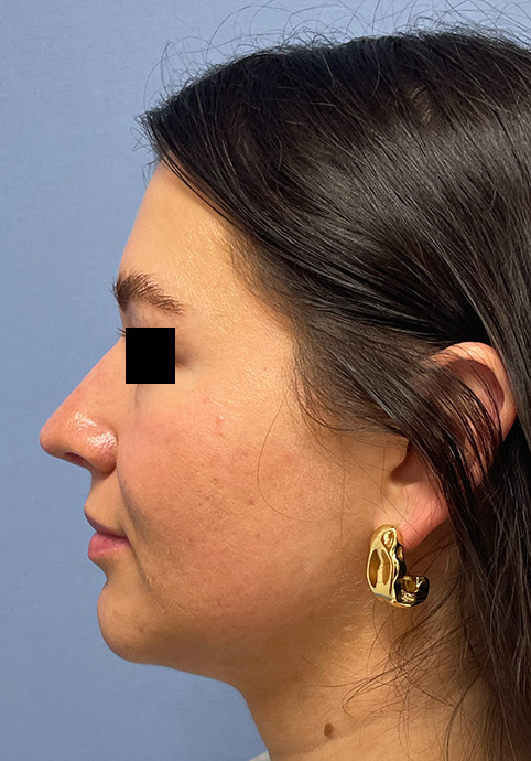 RHINOPLASTY Before & After Gallery - Patient 416568 - Image 9