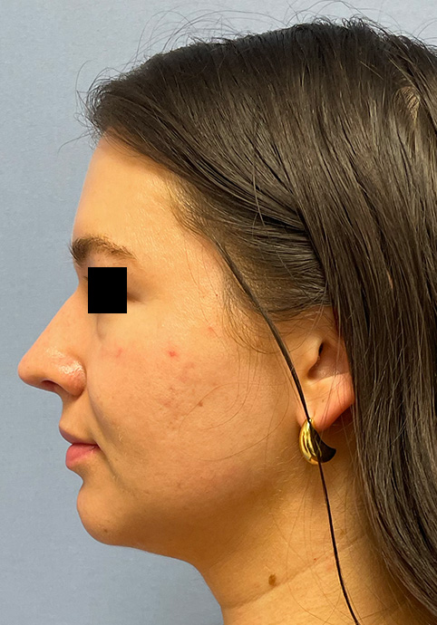 RHINOPLASTY Before & After Gallery - Patient 416568 - Image 10