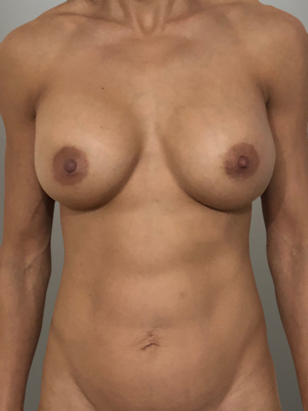 MOMMY MAKEOVER Before & After Gallery - Patient 143684 - Image 2