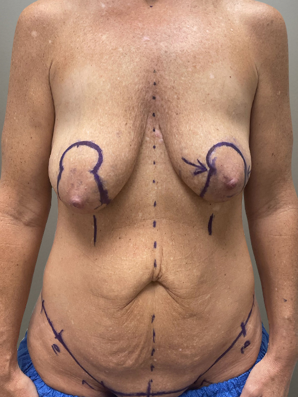 MOMMY MAKEOVER Before & After Gallery - Patient 149742 - Image 1