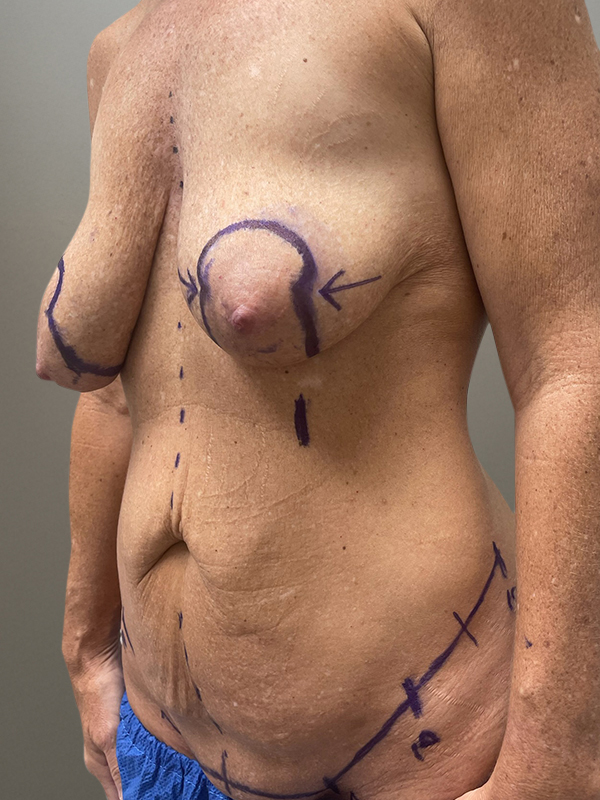 MOMMY MAKEOVER Before & After Gallery - Patient 149742 - Image 9