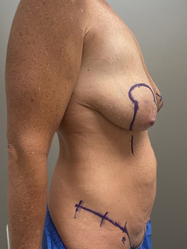 MOMMY MAKEOVER Before & After Gallery - Patient 149742 - Image 5