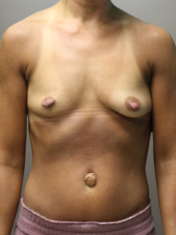 MOMMY MAKEOVER Before & After Gallery - Patient 151530 - Image 1