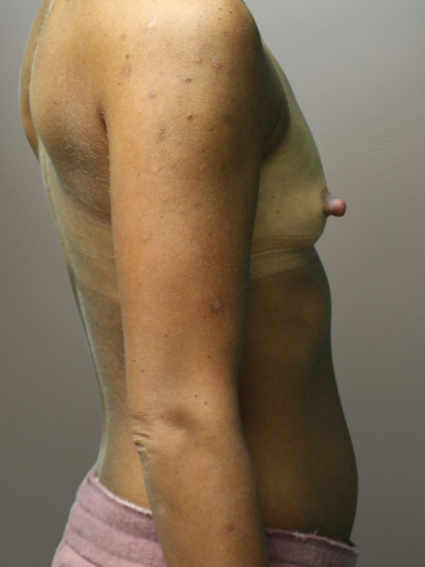 MOMMY MAKEOVER Before & After Gallery - Patient 151530 - Image 7