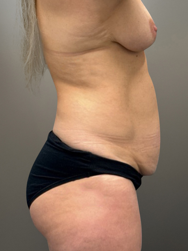 MOMMY MAKEOVER Before & After Gallery - Patient 152614 - Image 5