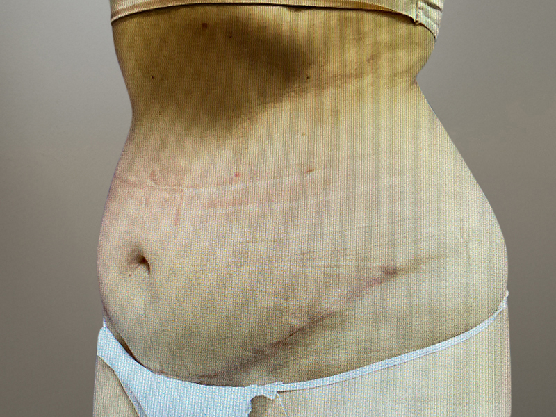 LIPOSUCTION Before & After Gallery - Patient 768005 - Image 3