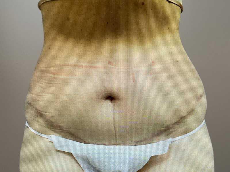 LIPOSUCTION Before & After Gallery - Patient 768005 - Image 1