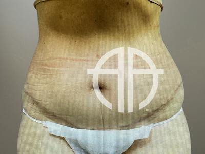LIPOSUCTION Before & After Gallery - Patient 768005 - Image 1