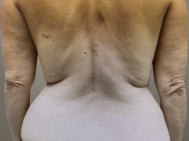 LIPOSUCTION Before & After Gallery - Patient 768005 - Image 5