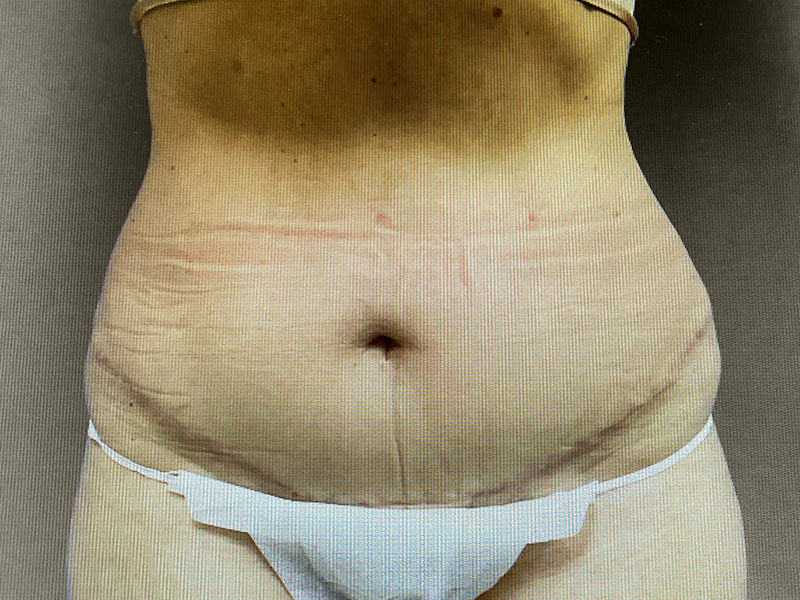 TUMMY TUCK Before & After Gallery - Patient 181928 - Image 1