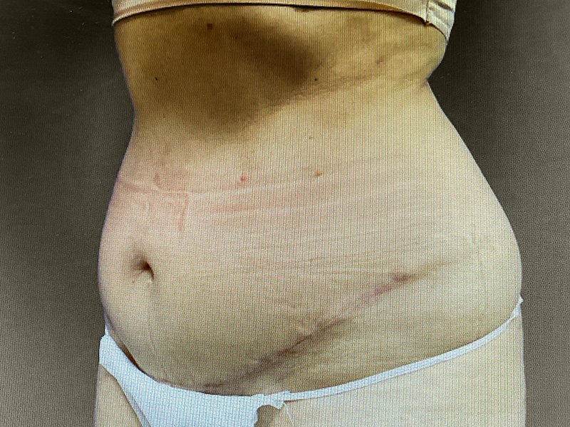 TUMMY TUCK Before & After Gallery - Patient 181928 - Image 3