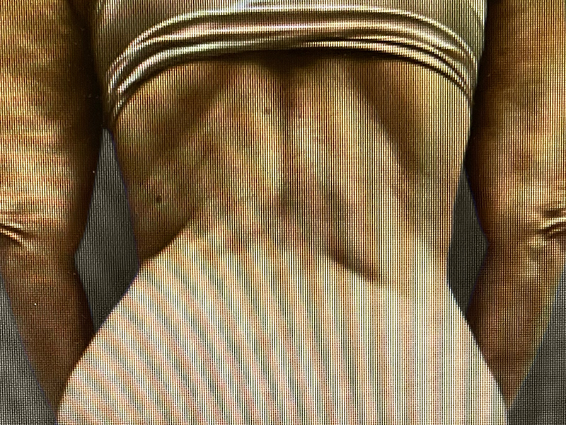 TUMMY TUCK Before & After Gallery - Patient 181928 - Image 6