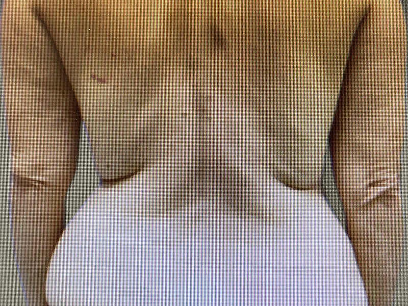 TUMMY TUCK Before & After Gallery - Patient 181928 - Image 5