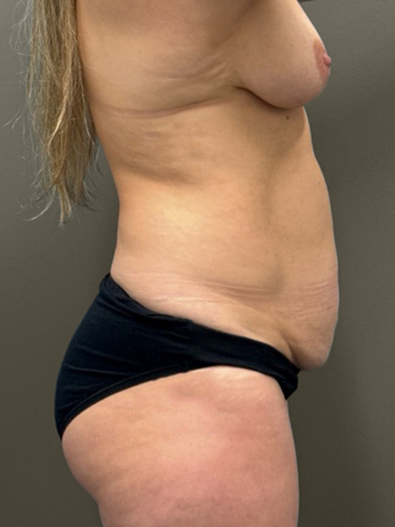 TUMMY TUCK Before & After Gallery - Patient 223535 - Image 5