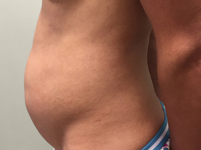 TUMMY TUCK Before & After Gallery - Patient 235073 - Image 3