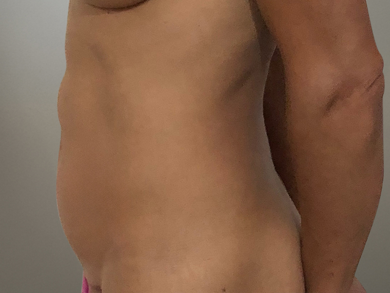 TUMMY TUCK Before & After Gallery - Patient 235073 - Image 4