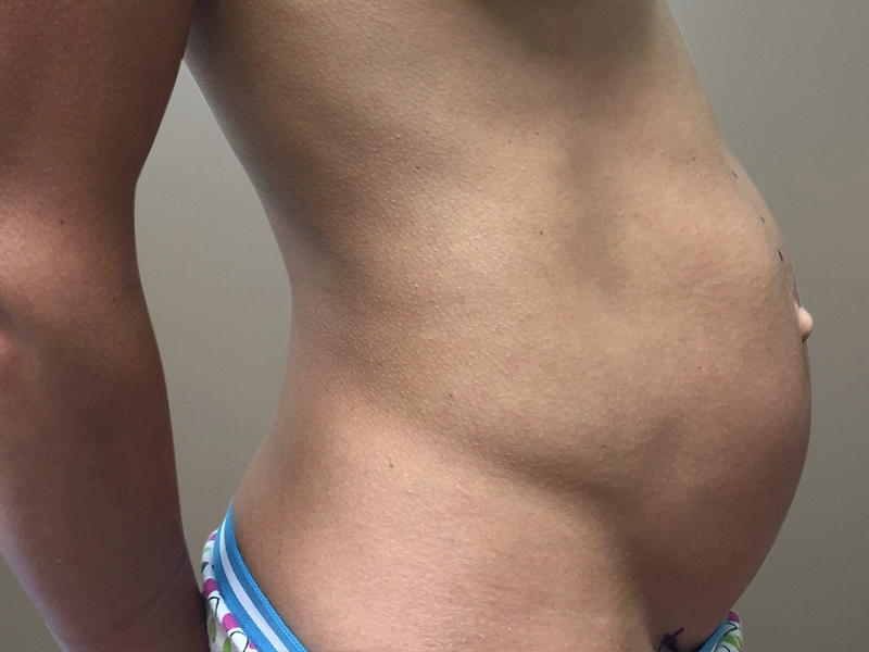 TUMMY TUCK Before & After Gallery - Patient 235073 - Image 1