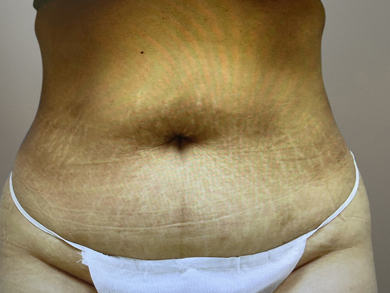 TUMMY TUCK Before & After Gallery - Patient 269032 - Image 1
