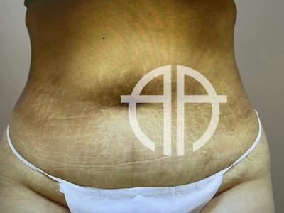 TUMMY TUCK Before & After Gallery - Patient 269032 - Image 1