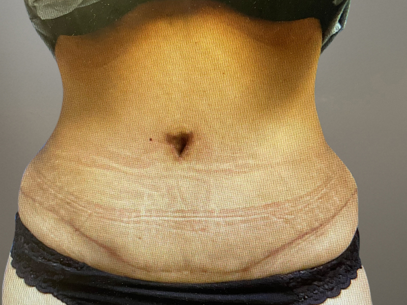 TUMMY TUCK Before & After Gallery - Patient 269032 - Image 2