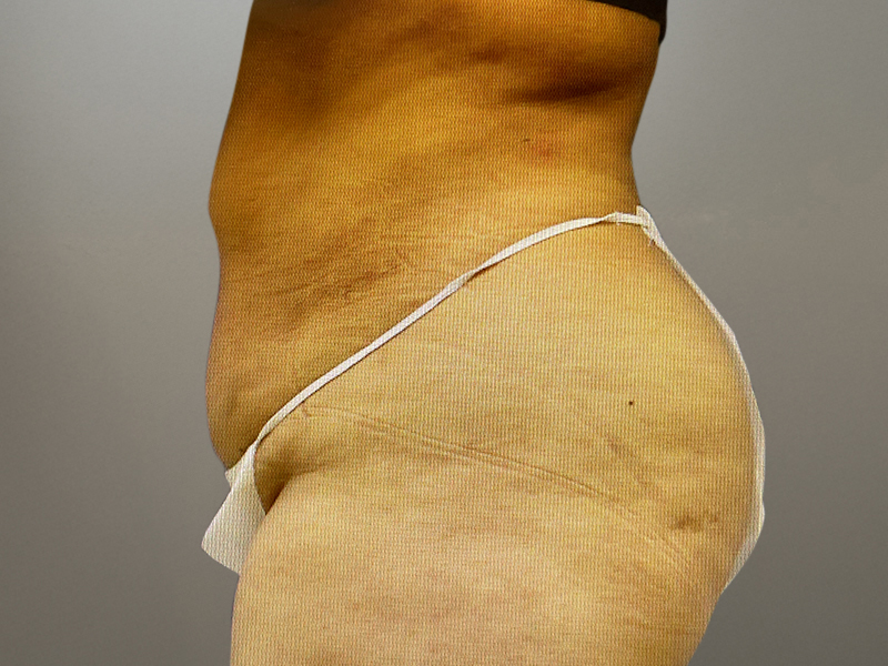 TUMMY TUCK Before & After Gallery - Patient 269032 - Image 3