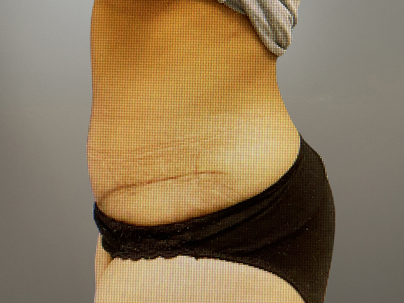 TUMMY TUCK Before & After Gallery - Patient 269032 - Image 4