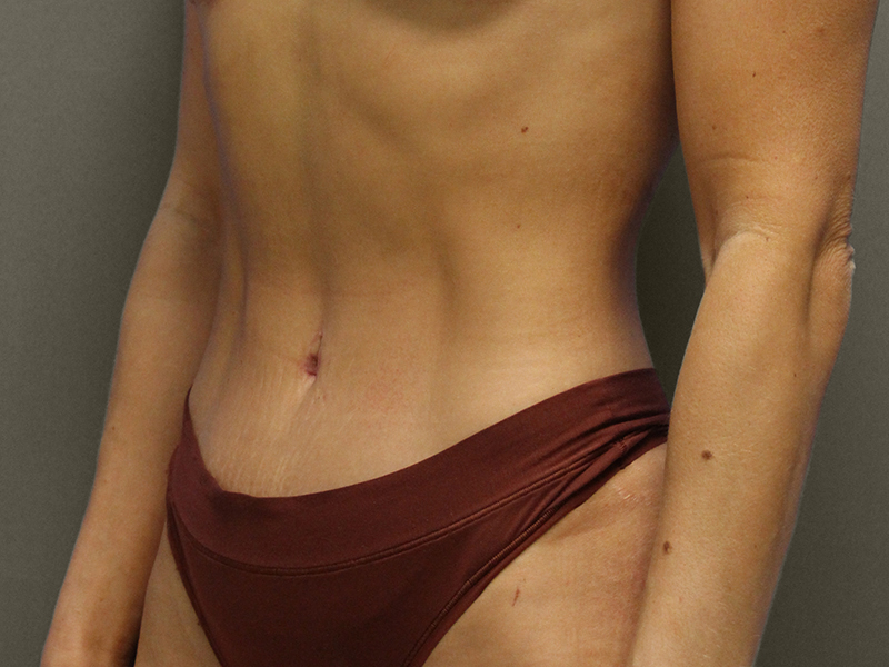 TUMMY TUCK Before & After Gallery - Patient 373903 - Image 4