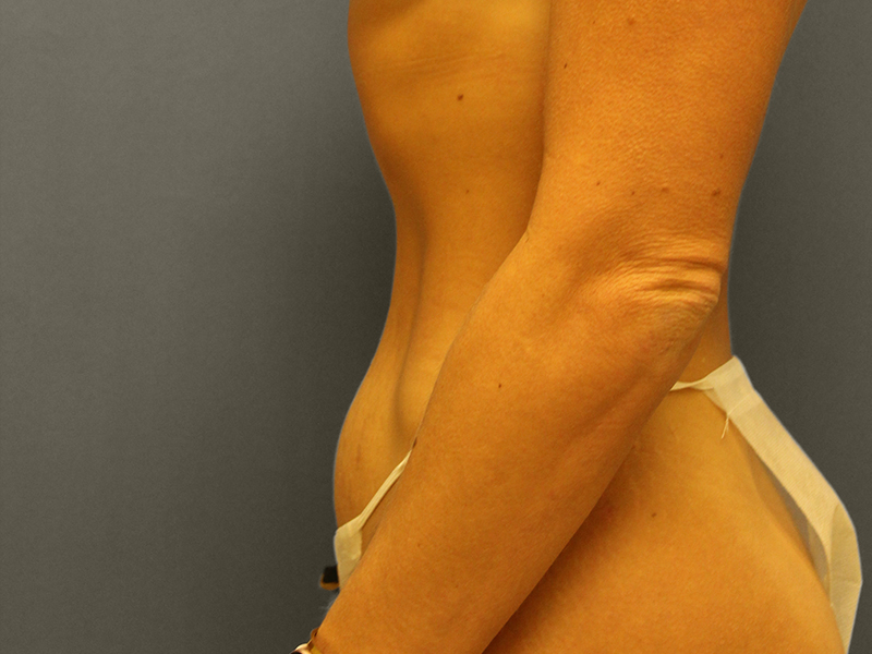 TUMMY TUCK Before & After Gallery - Patient 373903 - Image 5