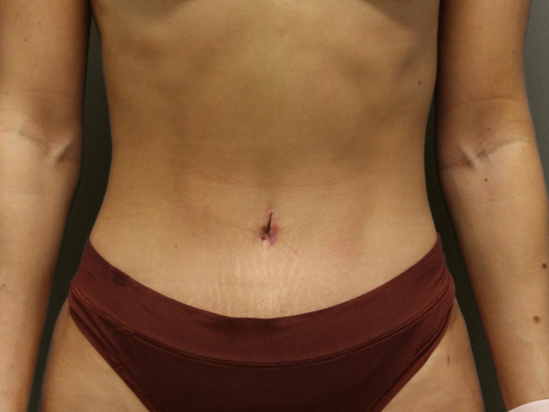 TUMMY TUCK Before & After Gallery - Patient 373903 - Image 2