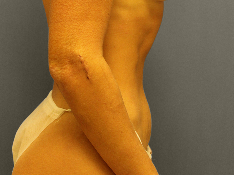 TUMMY TUCK Before & After Gallery - Patient 373903 - Image 7