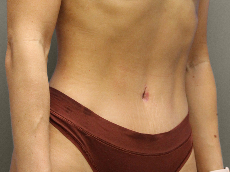 TUMMY TUCK Before & After Gallery - Patient 373903 - Image 10