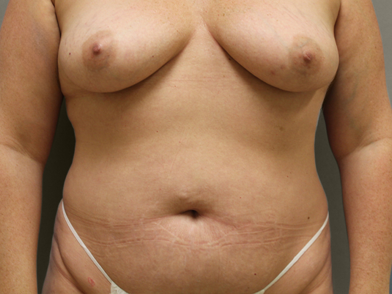 TUMMY TUCK Before & After Gallery - Patient 423989 - Image 1