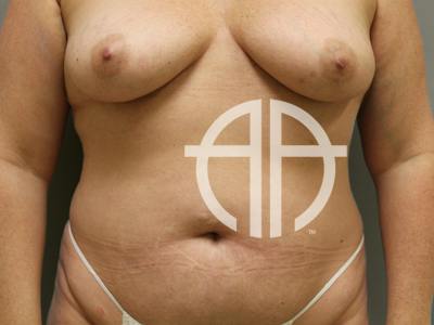 TUMMY TUCK Before & After Gallery - Patient 423989 - Image 1