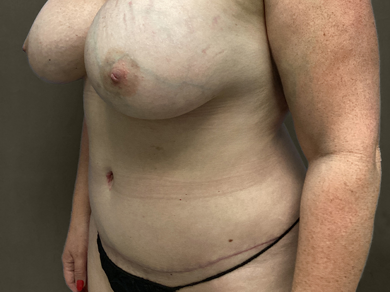 TUMMY TUCK Before & After Gallery - Patient 423989 - Image 10