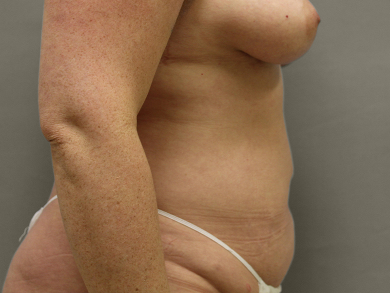 TUMMY TUCK Before & After Gallery - Patient 423989 - Image 5