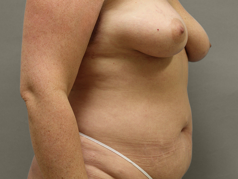 TUMMY TUCK Before & After Gallery - Patient 423989 - Image 3