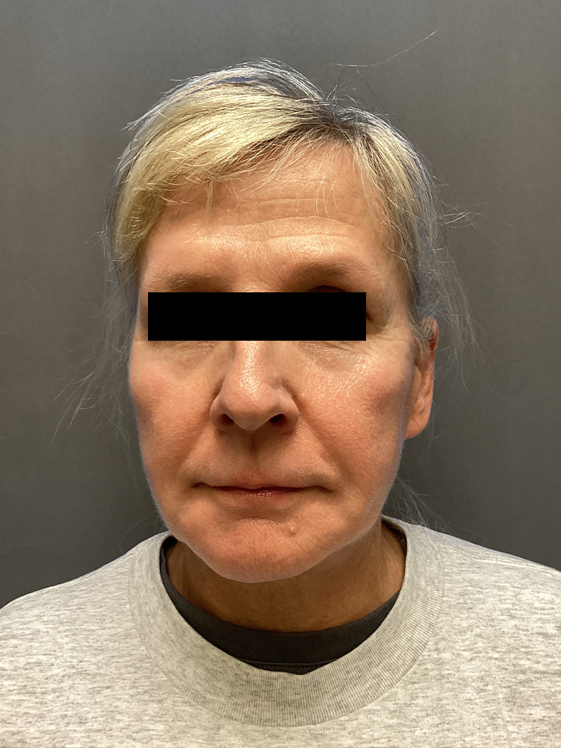 FACELIFT Before & After Gallery - Patient 174872 - Image 2