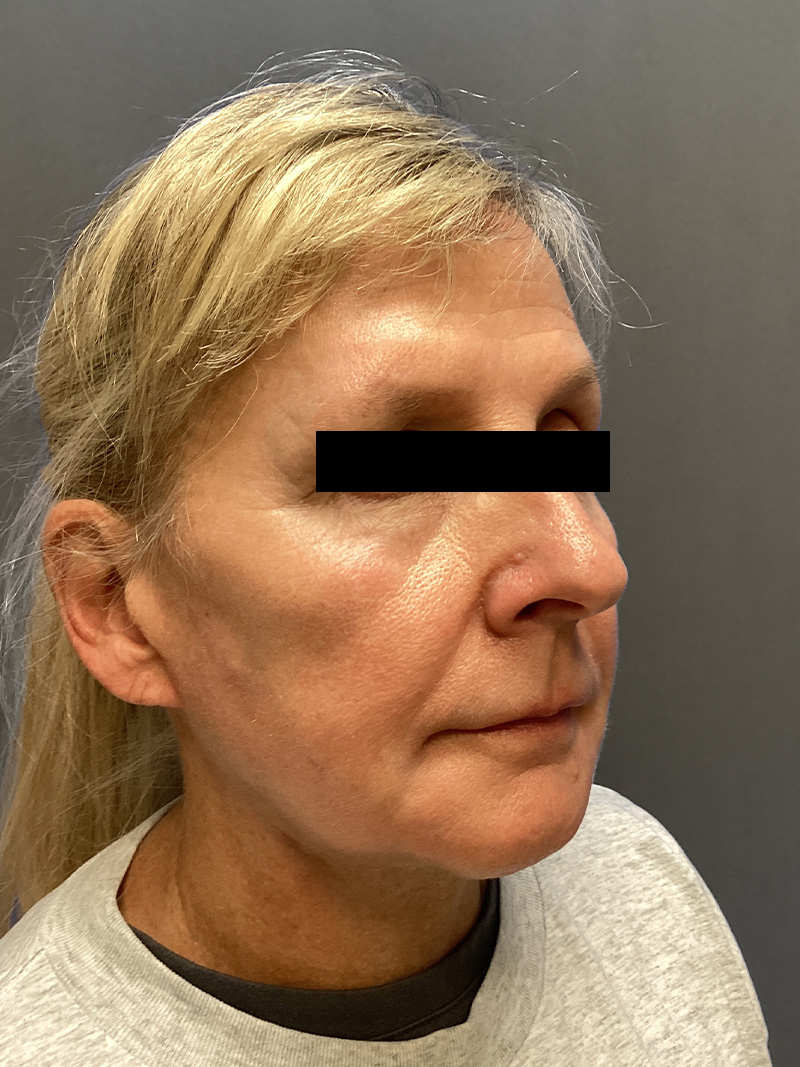FACELIFT Before & After Gallery - Patient 174872 - Image 4