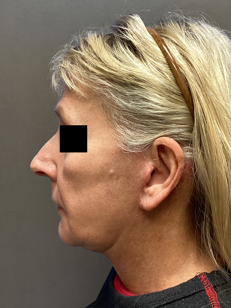 FACELIFT Before & After Gallery - Patient 174872 - Image 7