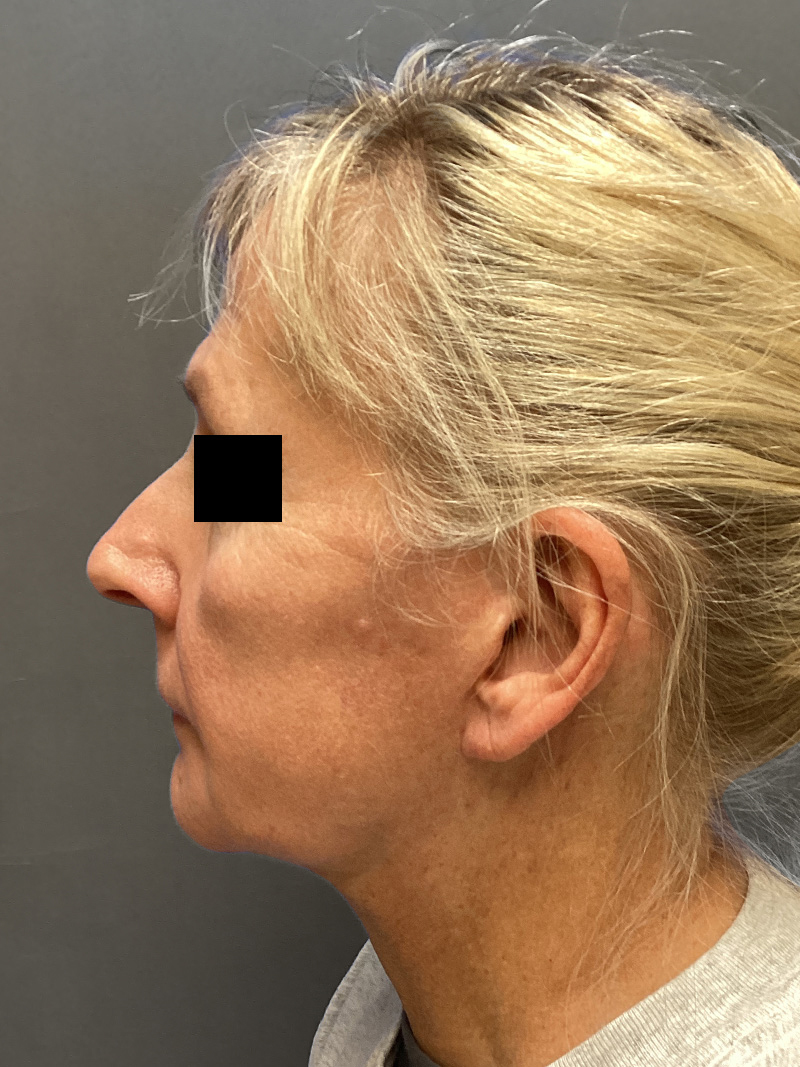 FACELIFT Before & After Gallery - Patient 174872 - Image 8