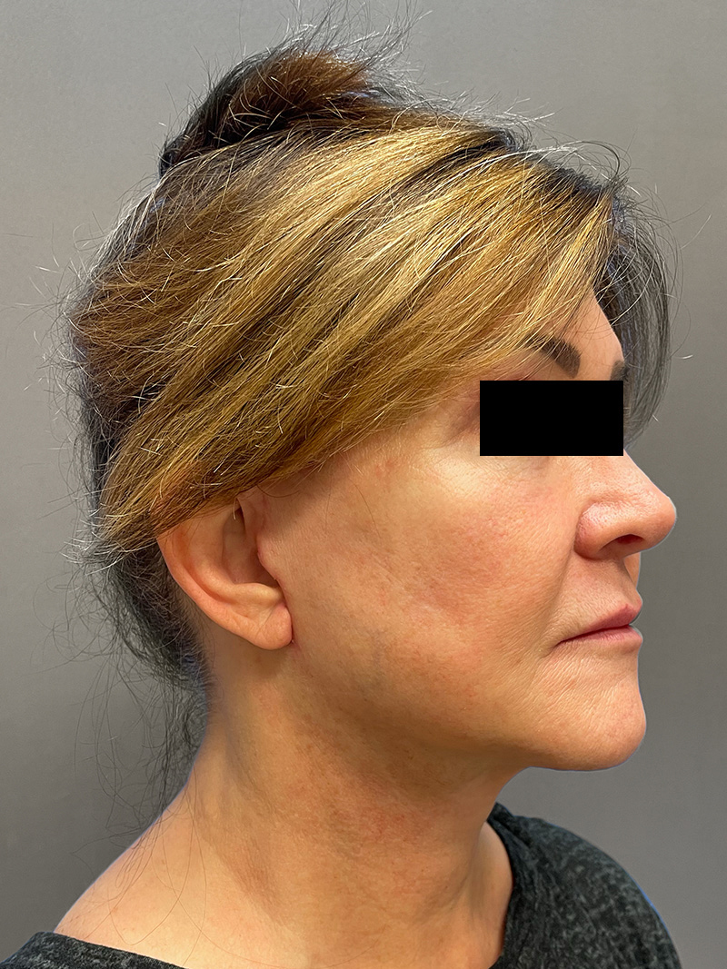 FACELIFT Before & After Gallery - Patient 192089 - Image 4