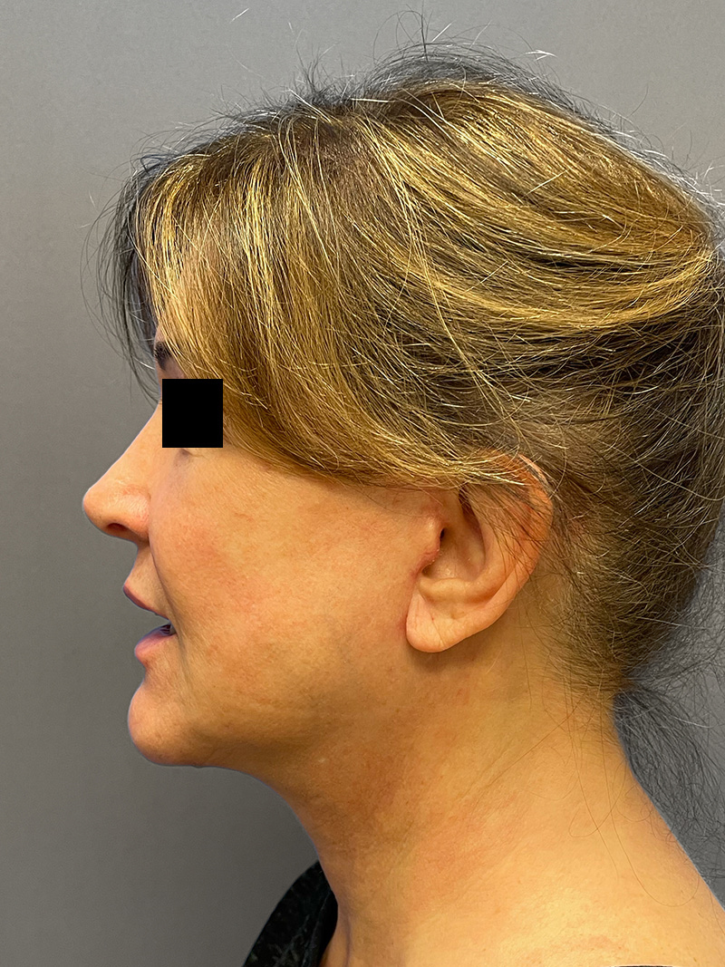 FACELIFT Before & After Gallery - Patient 192089 - Image 8