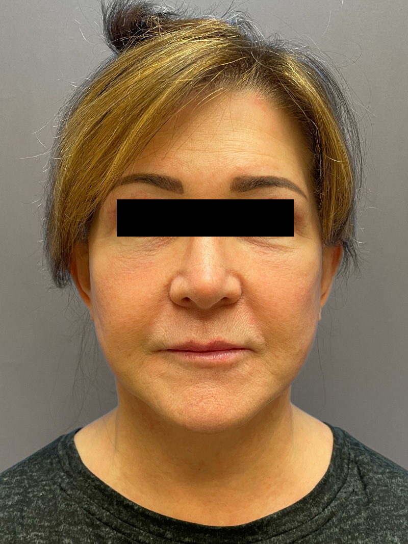 FACELIFT Before & After Gallery - Patient 192089 - Image 2